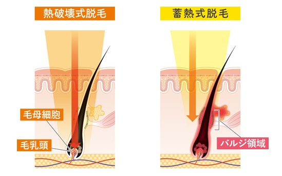 熱破壊式と蓄熱式脱毛の違い